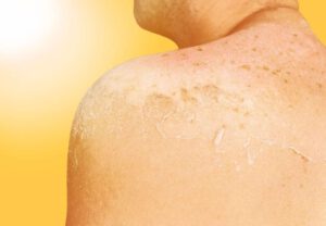Read more about the article 5 ways to soothe the sting of sunburn