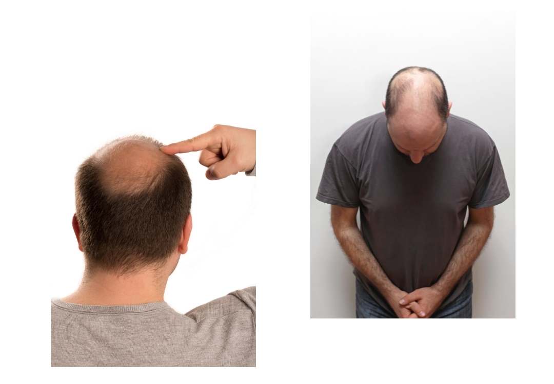 You are currently viewing A hair loss cure for men