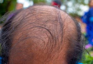 Read more about the article Bald heads