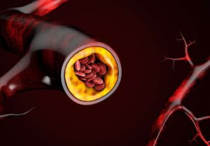 Read more about the article Why high blood cholesterol is dangerous