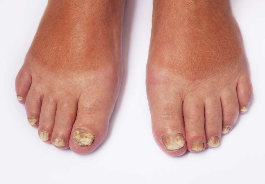5 Killer Ways To Treat Athlete’s Foot We Golden Age