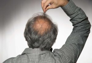 Read more about the article Balding Solution for Men and Women