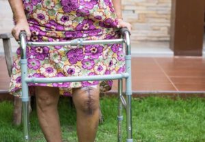 Read more about the article Knee replacement surgery