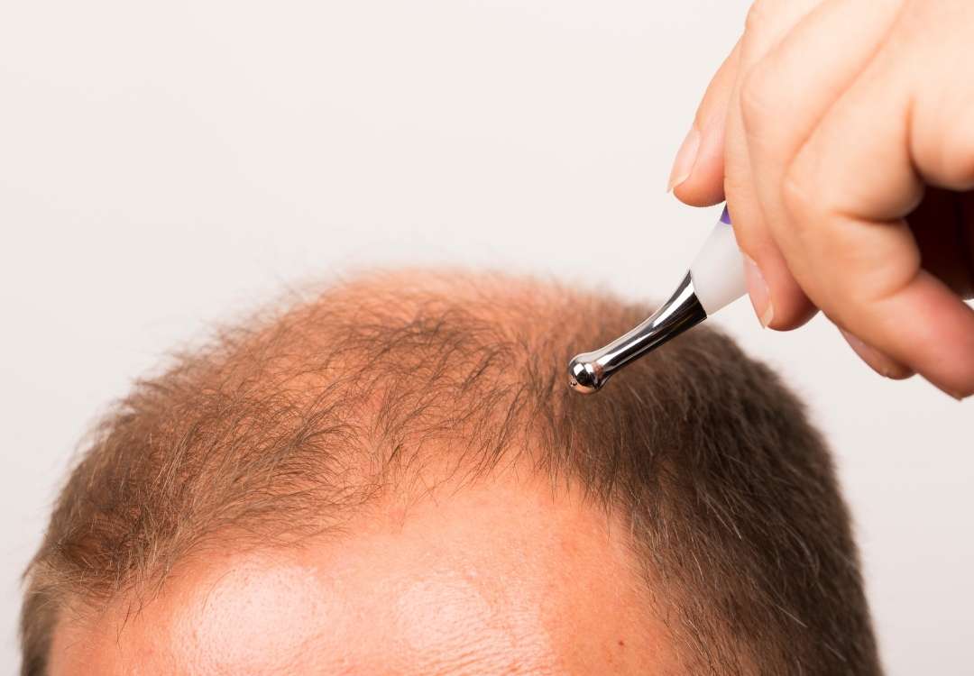 You are currently viewing Vitamins and hair loss