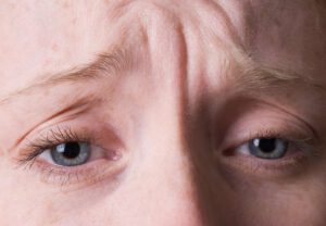 Read more about the article What Is Brow Lift?