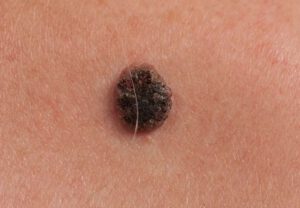 Read more about the article Skin cancer on the face beginning